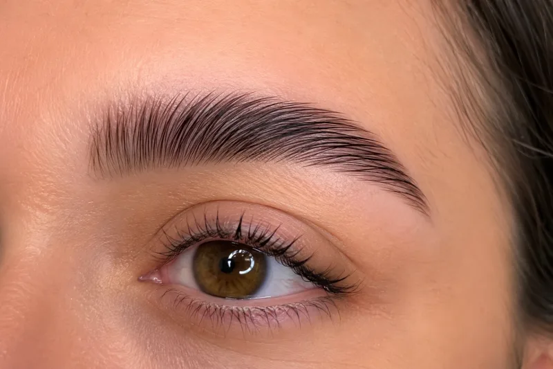Brow lift